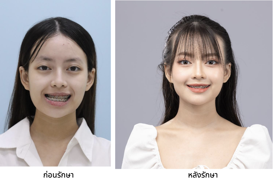 What should you know before getting braces? 5 things to know if you want to adjust your facial structure