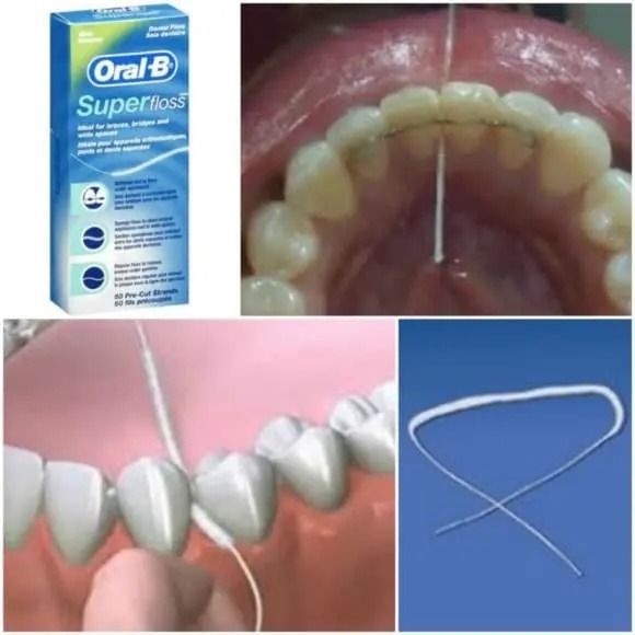 How to Take Care of Your Braces: 7 Dentist-Recommended Tips for Maintaining Oral Health