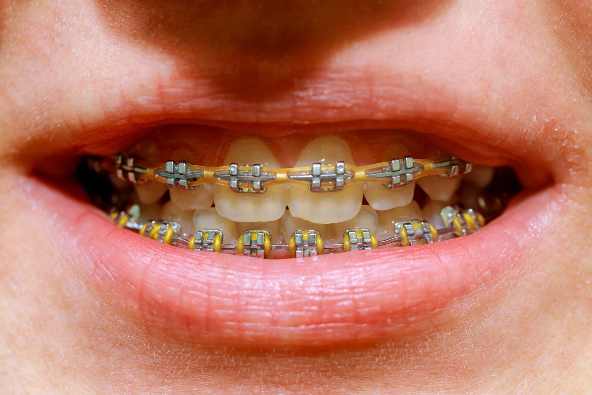 How to Take Care of Your Braces: 7 Dentist-Recommended Tips for Maintaining Oral Health