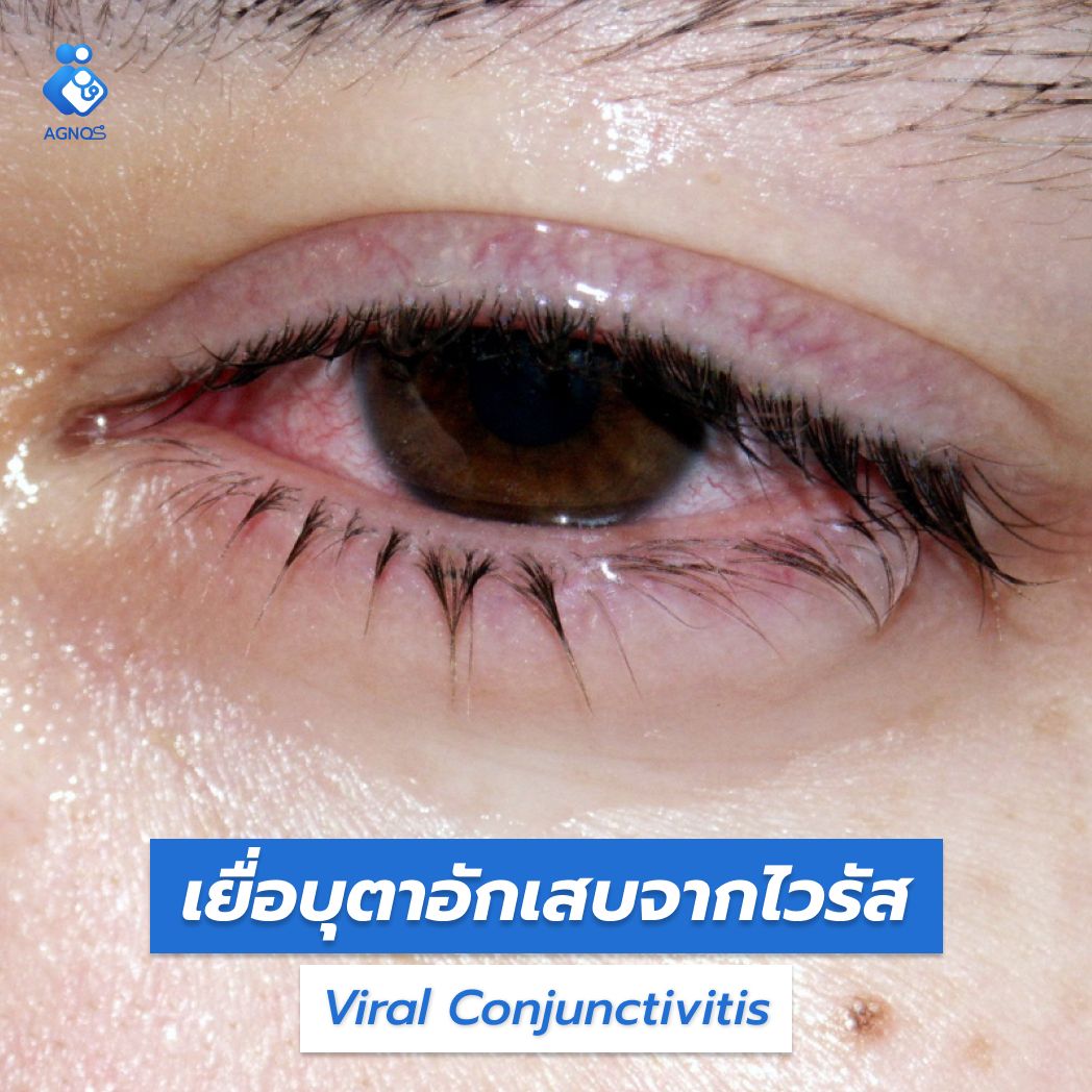 เยื่อบุตาอักเสบจากไวรัส
(Viral Conjunctivitis)