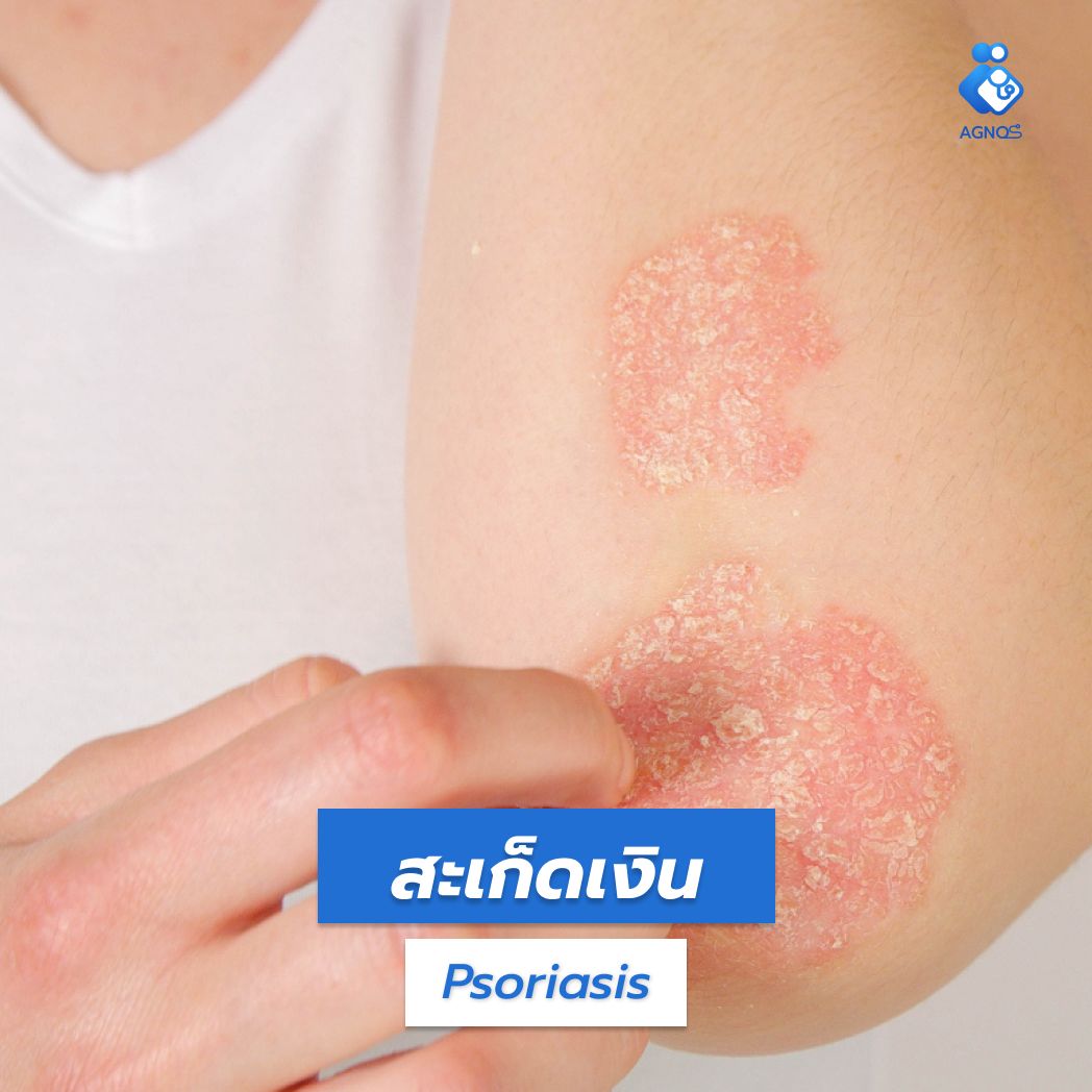 สะเก็ดเงิน (Psoriasis)