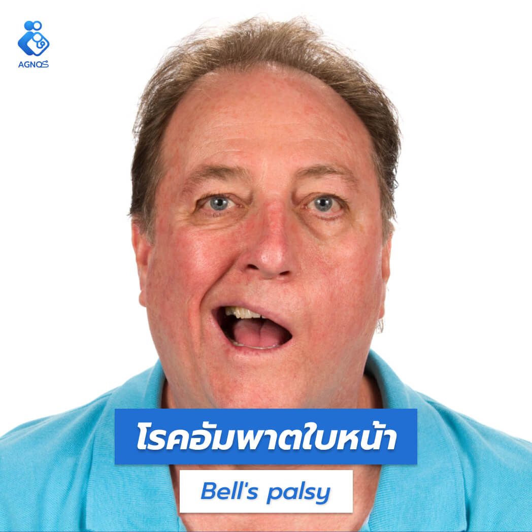 โรคอัมพาตใบหน้า (Bell's palsy)