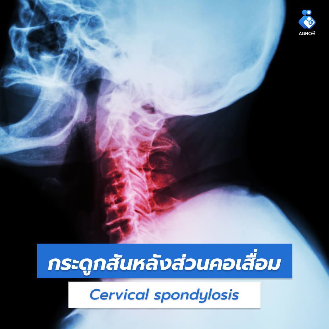 กระดูกสันหลังส่วนคอเสื่อม
(Cervical spondylosis)