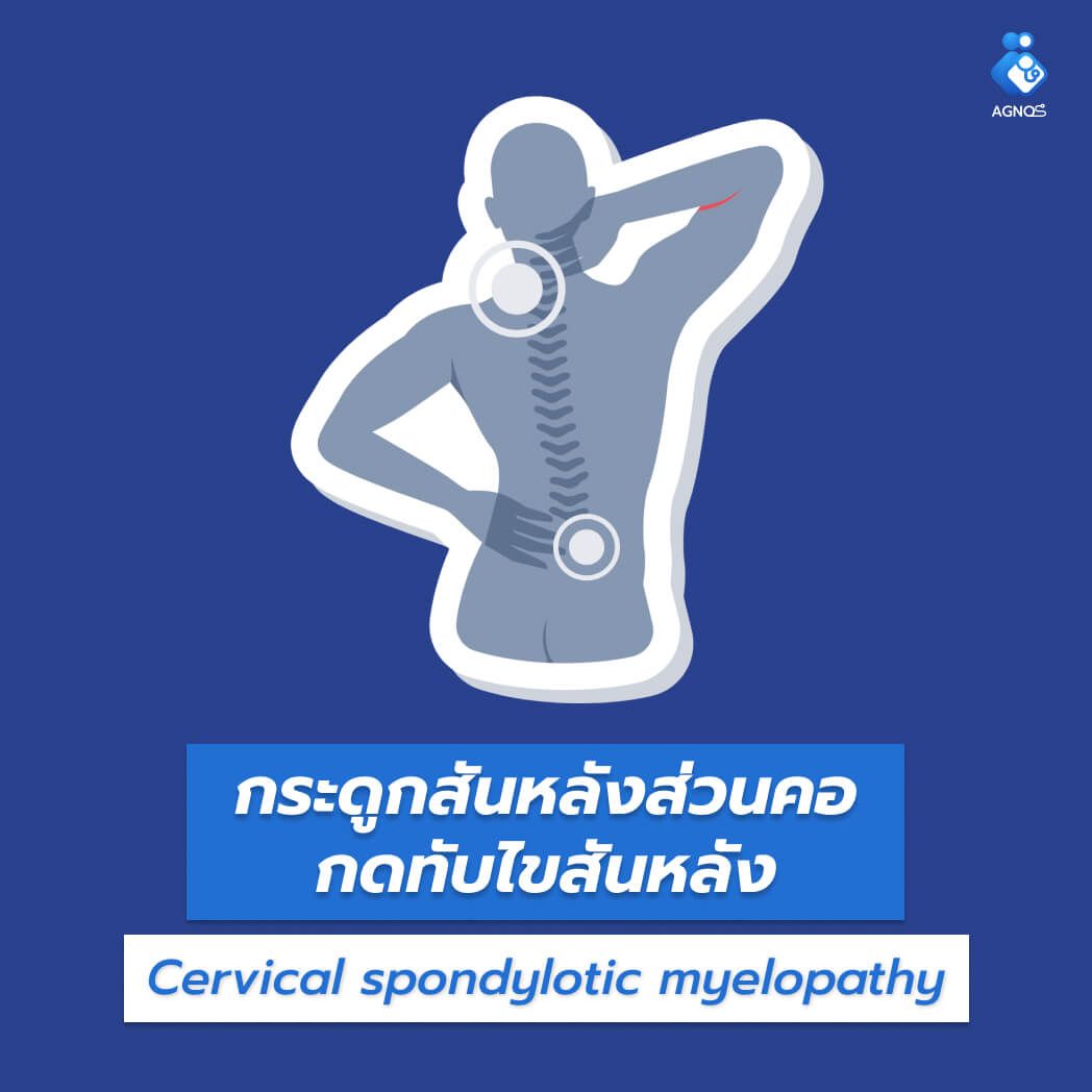 กระดูกสันหลังส่วนคอกดทับไขสันหลัง
(Cervical spondylotic myelopathy)