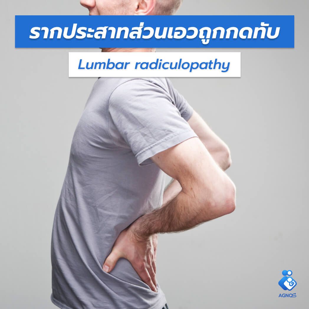 รากประสาทส่วนเอวถูกกดทับ
(Lumbar radiculopathy)