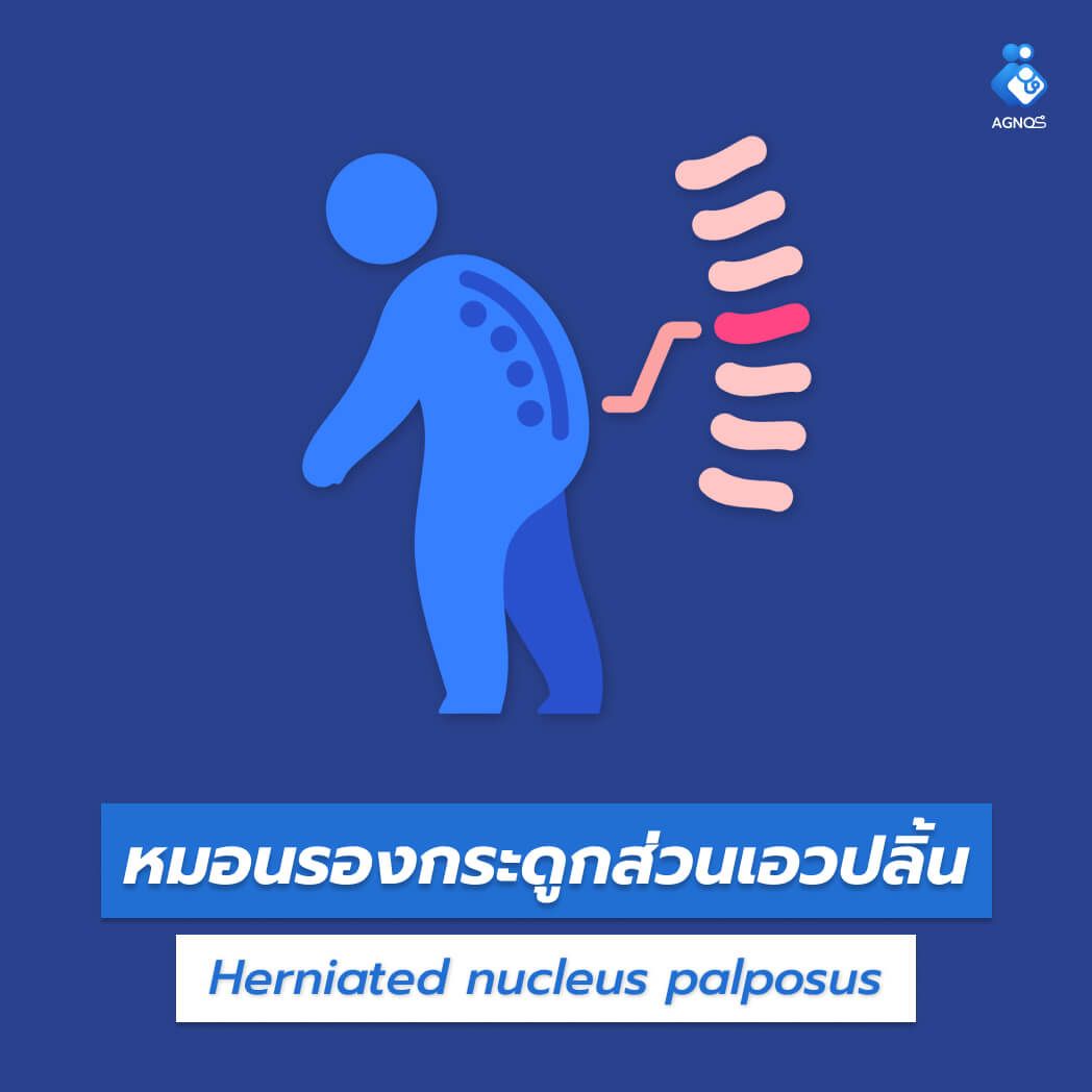 หมอนรองกระดูกส่วนเอวปลิ้น
(Herniated nucleus palposus)