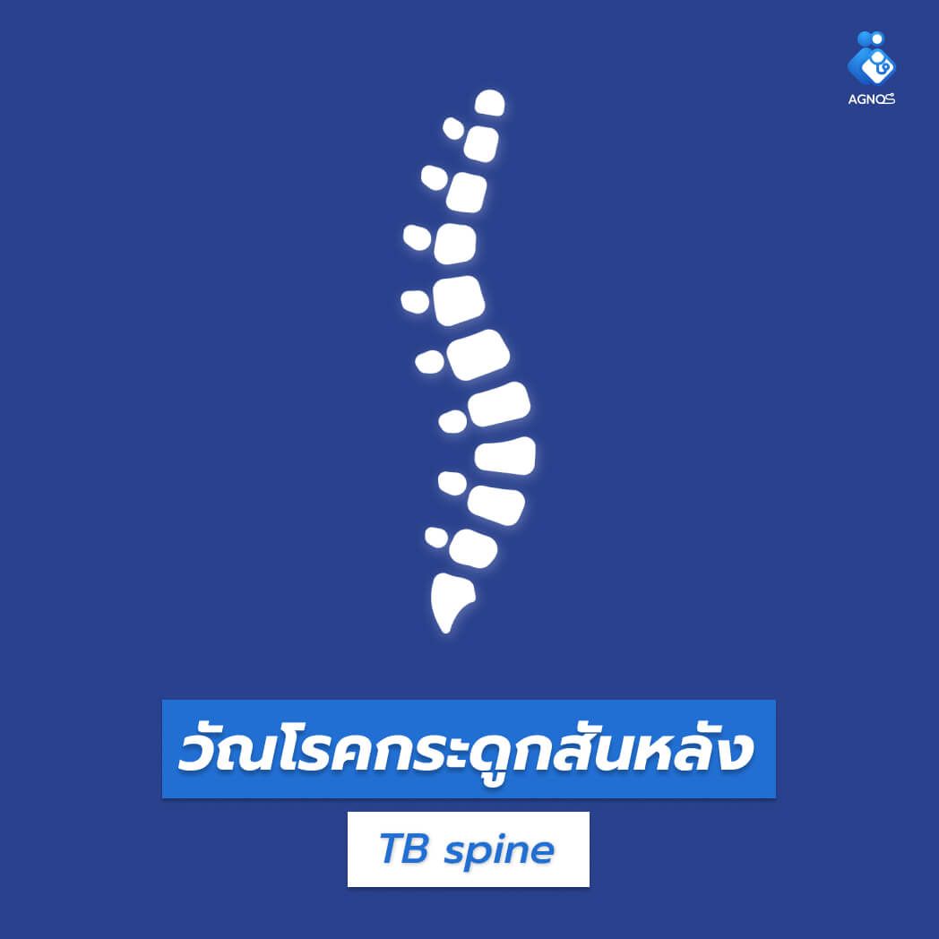 วัณโรคกระดูกสันหลัง (TB spine)