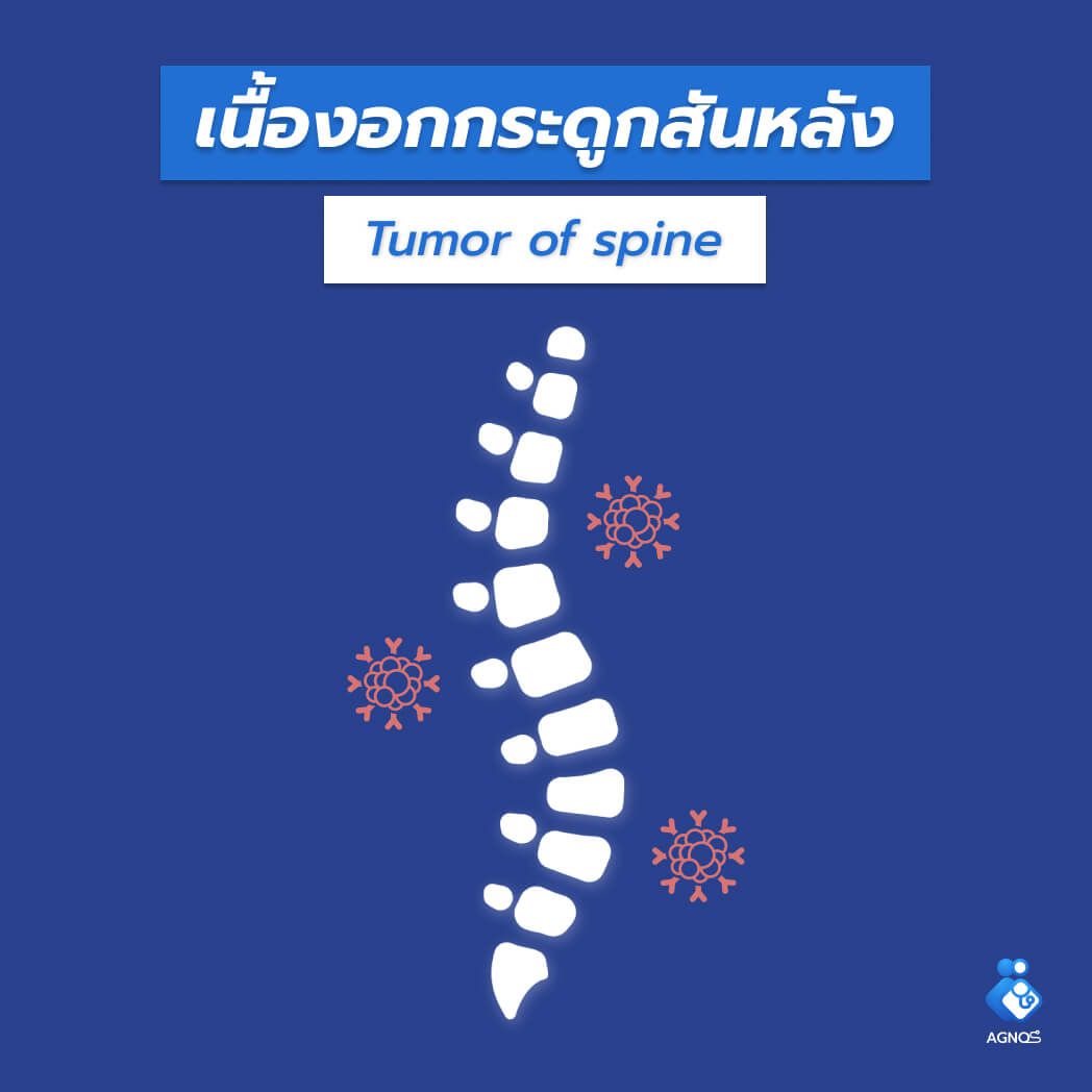 เนื้องอกกระดูกสันหลัง (Tumor of
spine)