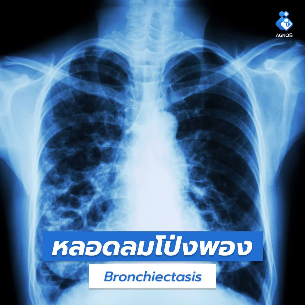 หลอดลมโป่งพอง (Bronchiectasis)