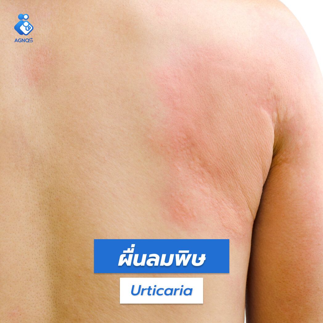 ผื่นลมพิษ (Urticaria)