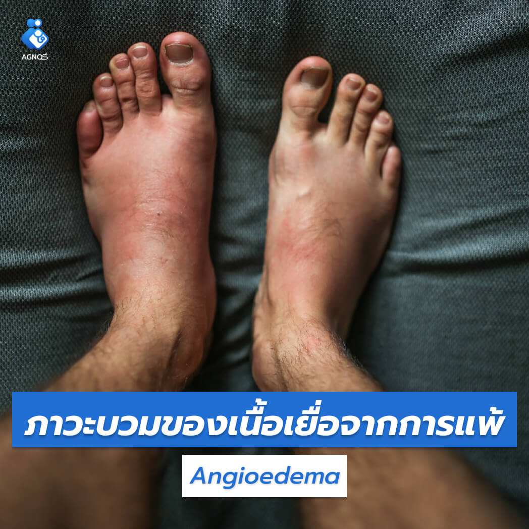 ภาวะบวมของเนื้อเยื่อจากการแพ้
    (Angioedema)