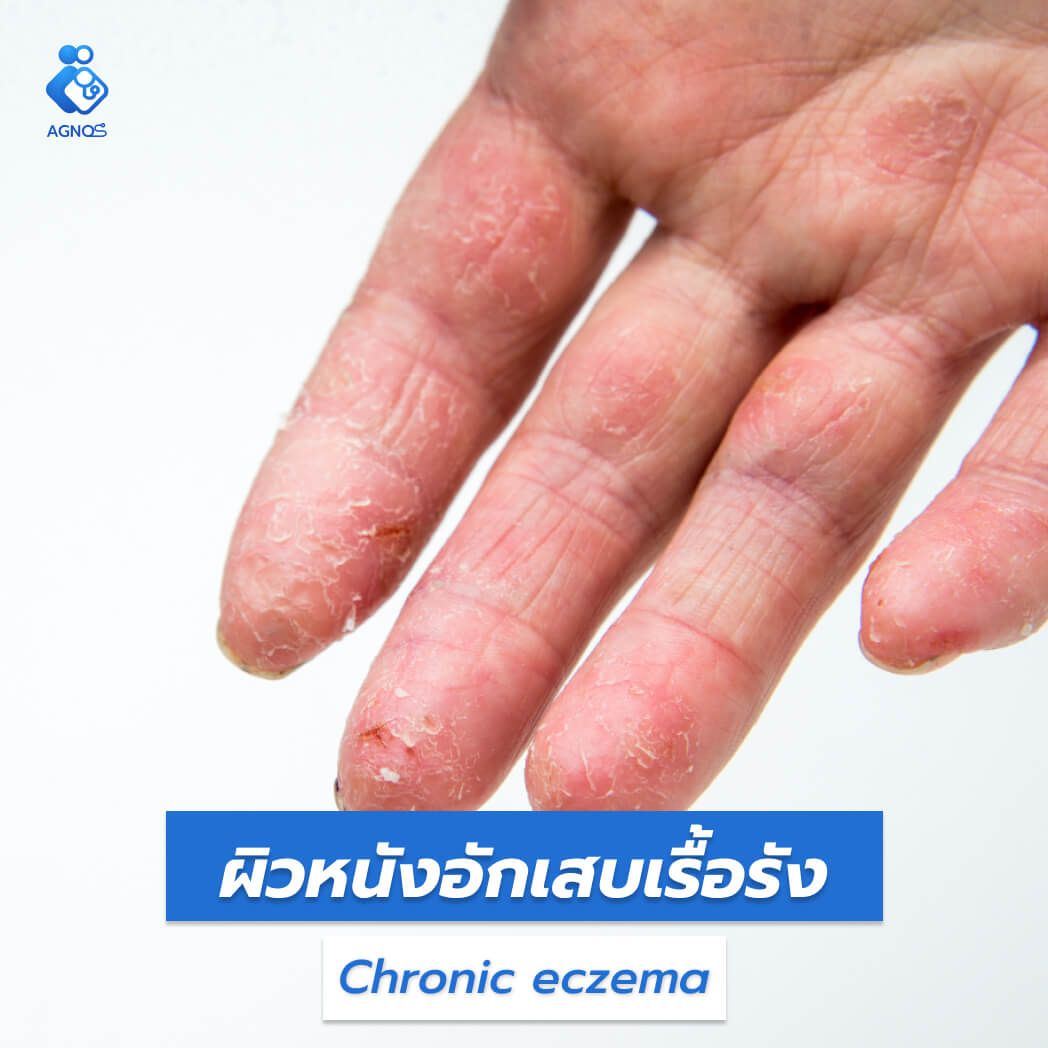 ผิวหนังอักเสบเรื้อรัง (Chronic
eczema)
