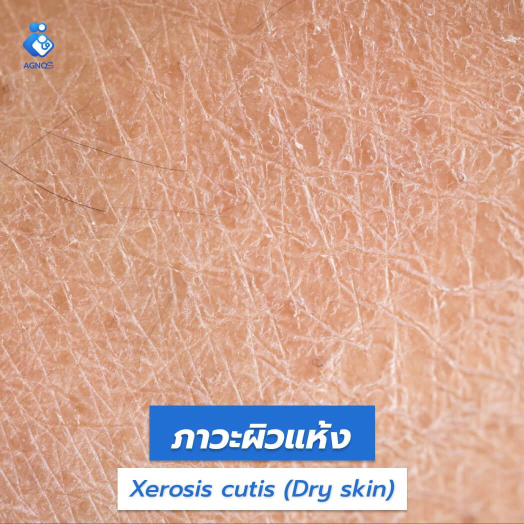 ภาวะผิวแห้ง (Xerosis cutis (Dry
skin))