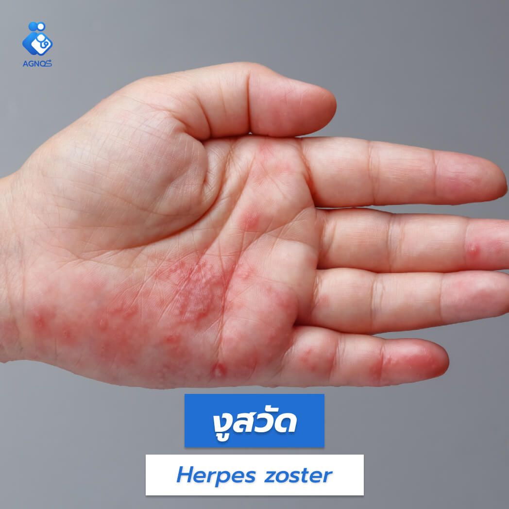 งูสวัด (Herpes zoster)
