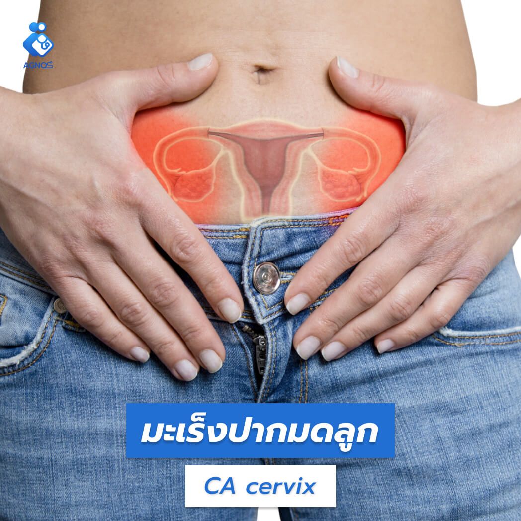 มะเร็งปากมดลูก (CA cervix)