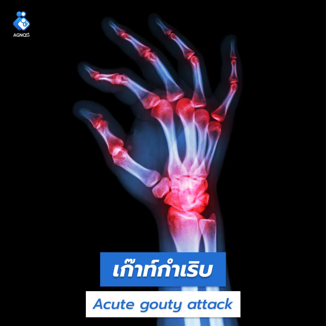 เก๊าต์กำเริบ (Acute gouty
attack)