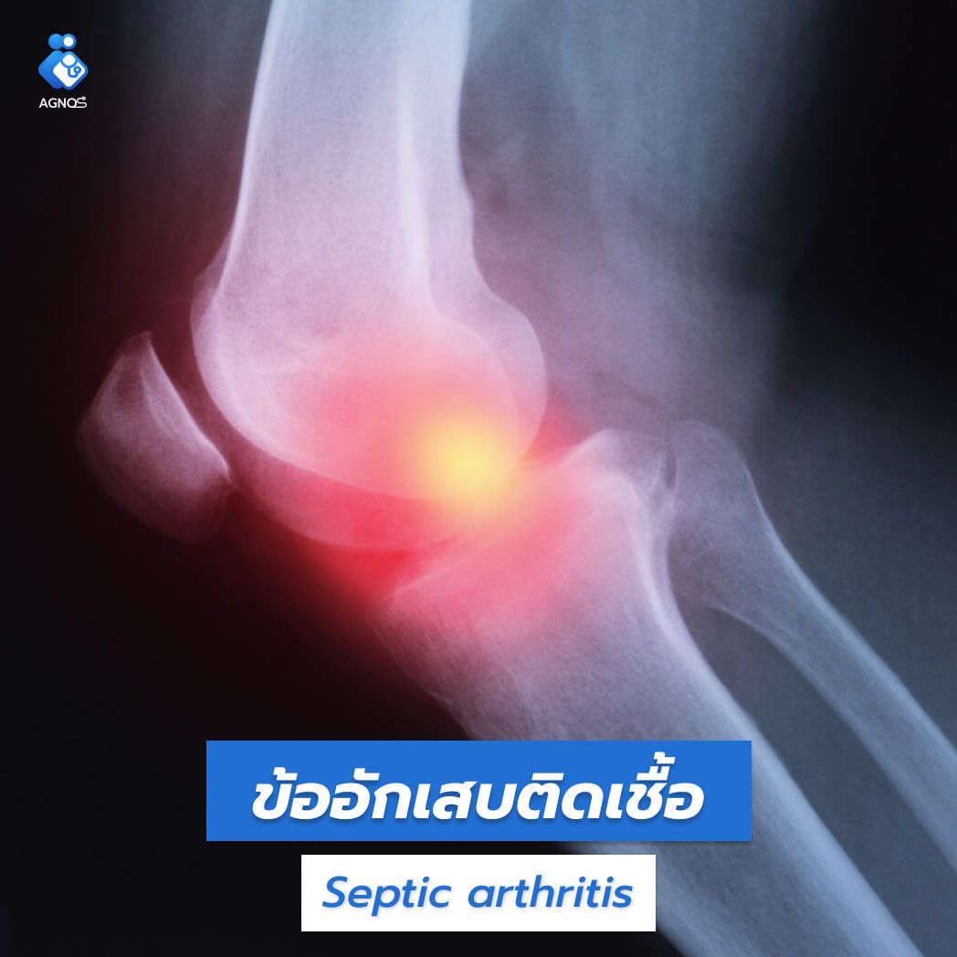 ข้ออักเสบติดเชื้อ (Septic
arthritis)