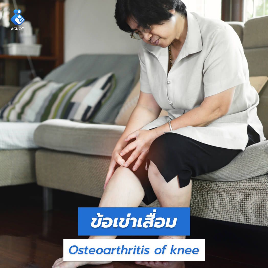 ข้อเข่าเสื่อม (Osteoarthritis of
knee)