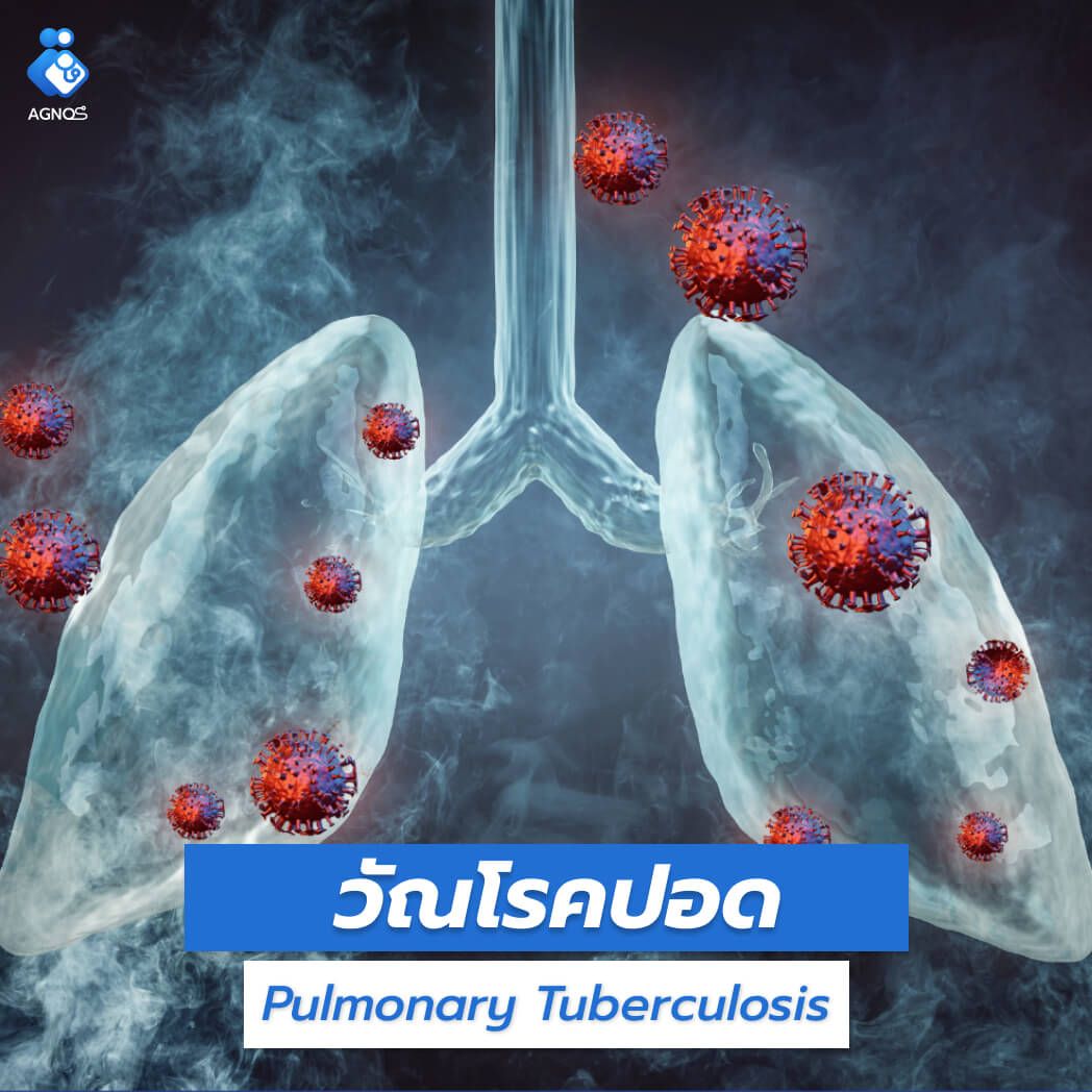 วัณโรคปอด (Pulmonary
Tuberculosis)