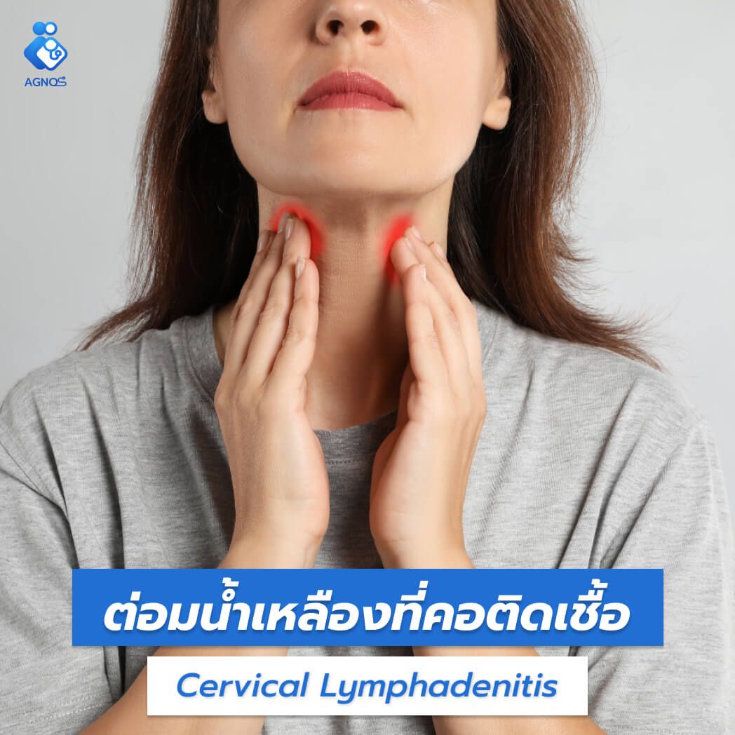ต่อมน้ำเหลืองที่คอติดเชื้อ
(Cervical Lymphadenitis)