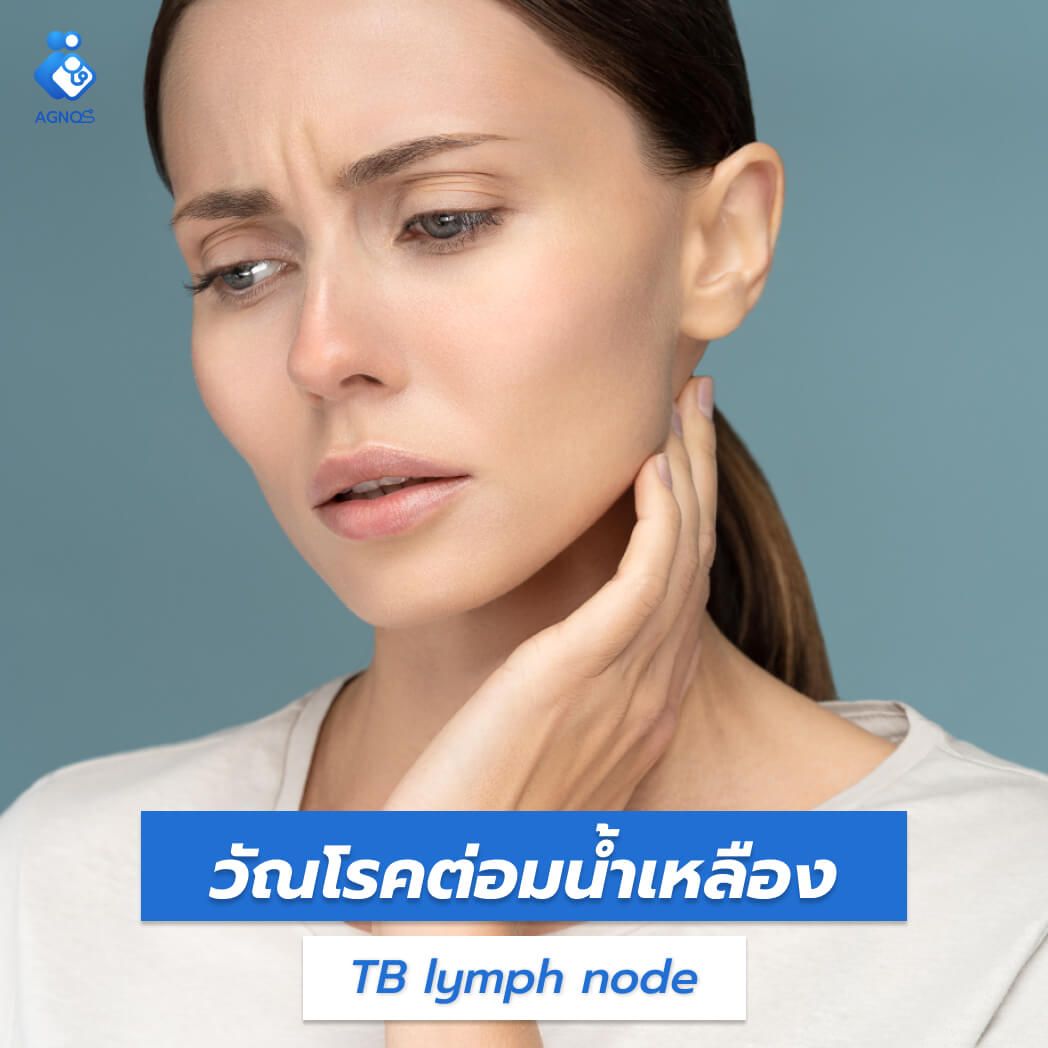 วัณโรคต่อมน้ำเหลือง (TB lymph
node)