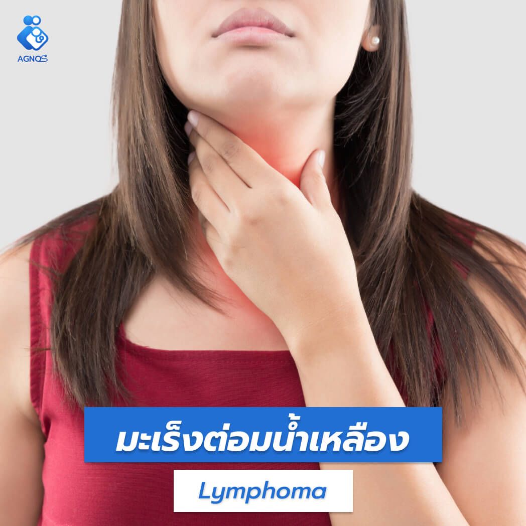 มะเร็งต่อมน้ำเหลือง (Lymphoma)