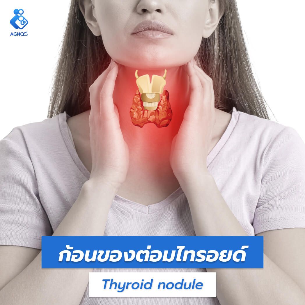 ก้อนของต่อมไทรอยด์ (Thyroid
nodule)