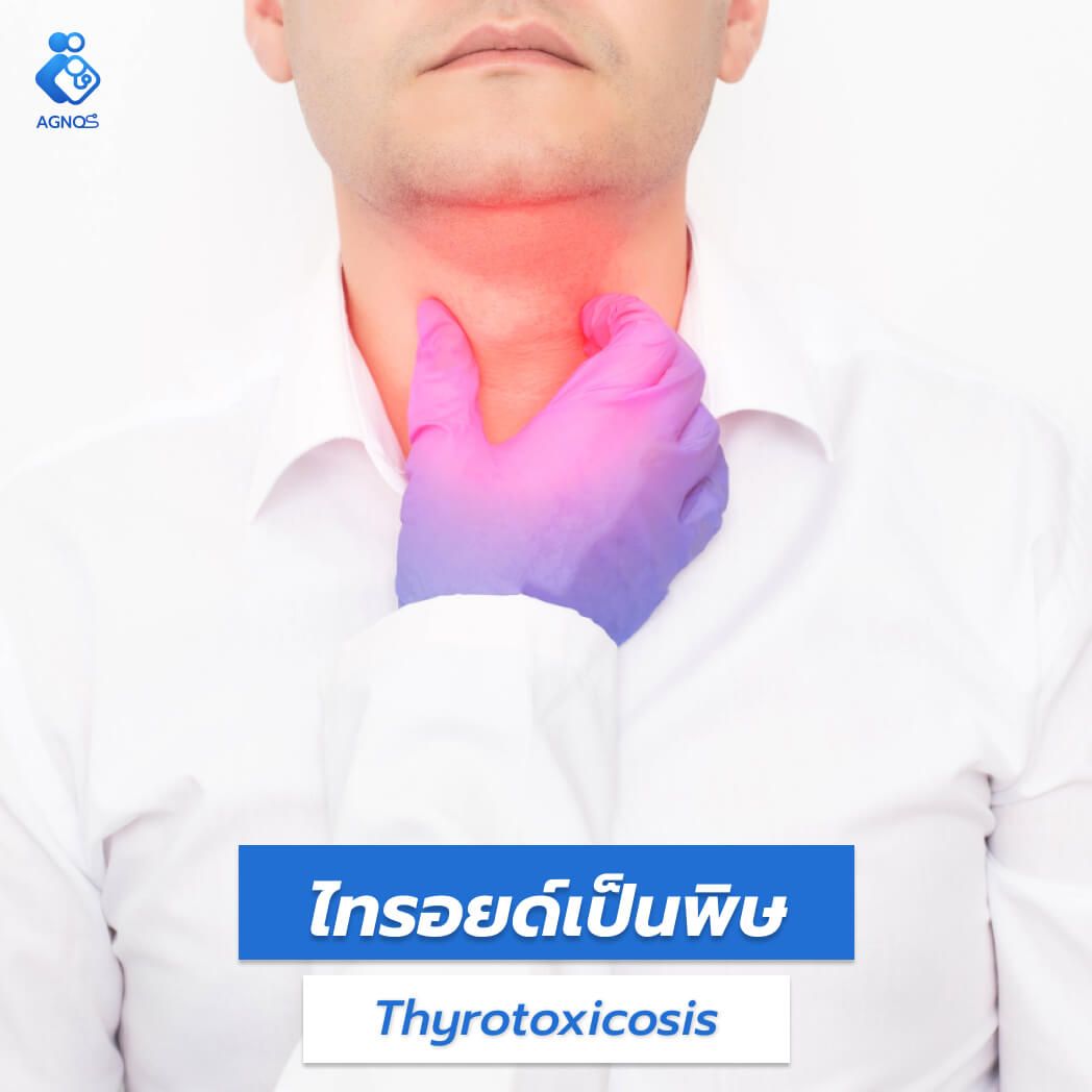 ไทรอยด์เป็นพิษ (Thyrotoxicosis)