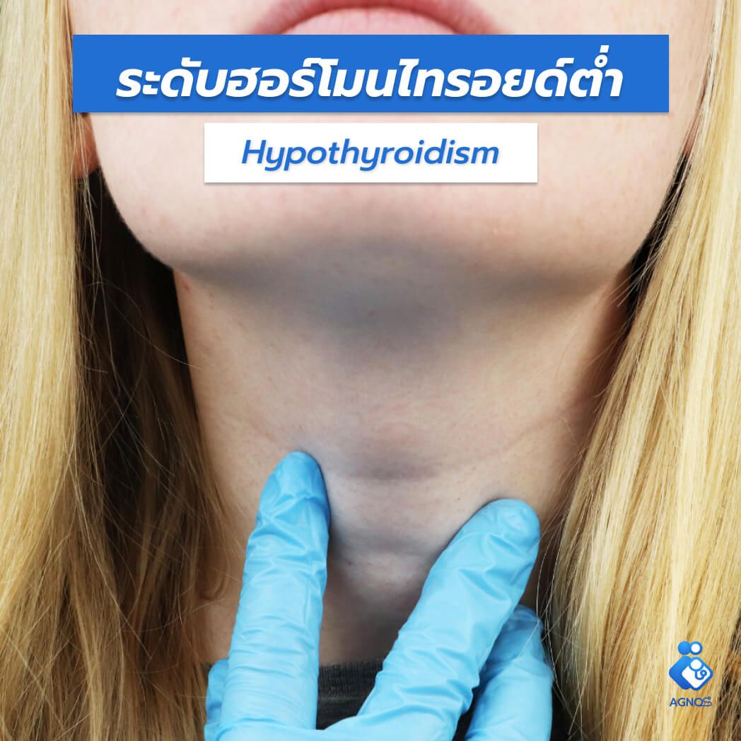 ระดับฮอร์โมนไทรอยด์ต่ำ (Hypothyroidism)