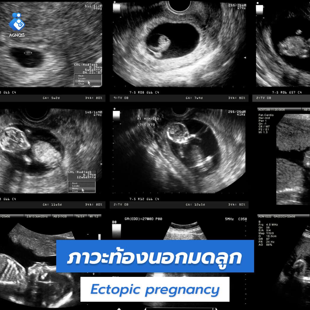 ภาวะท้องนอกมดลูก (Ectopic pregnancy)