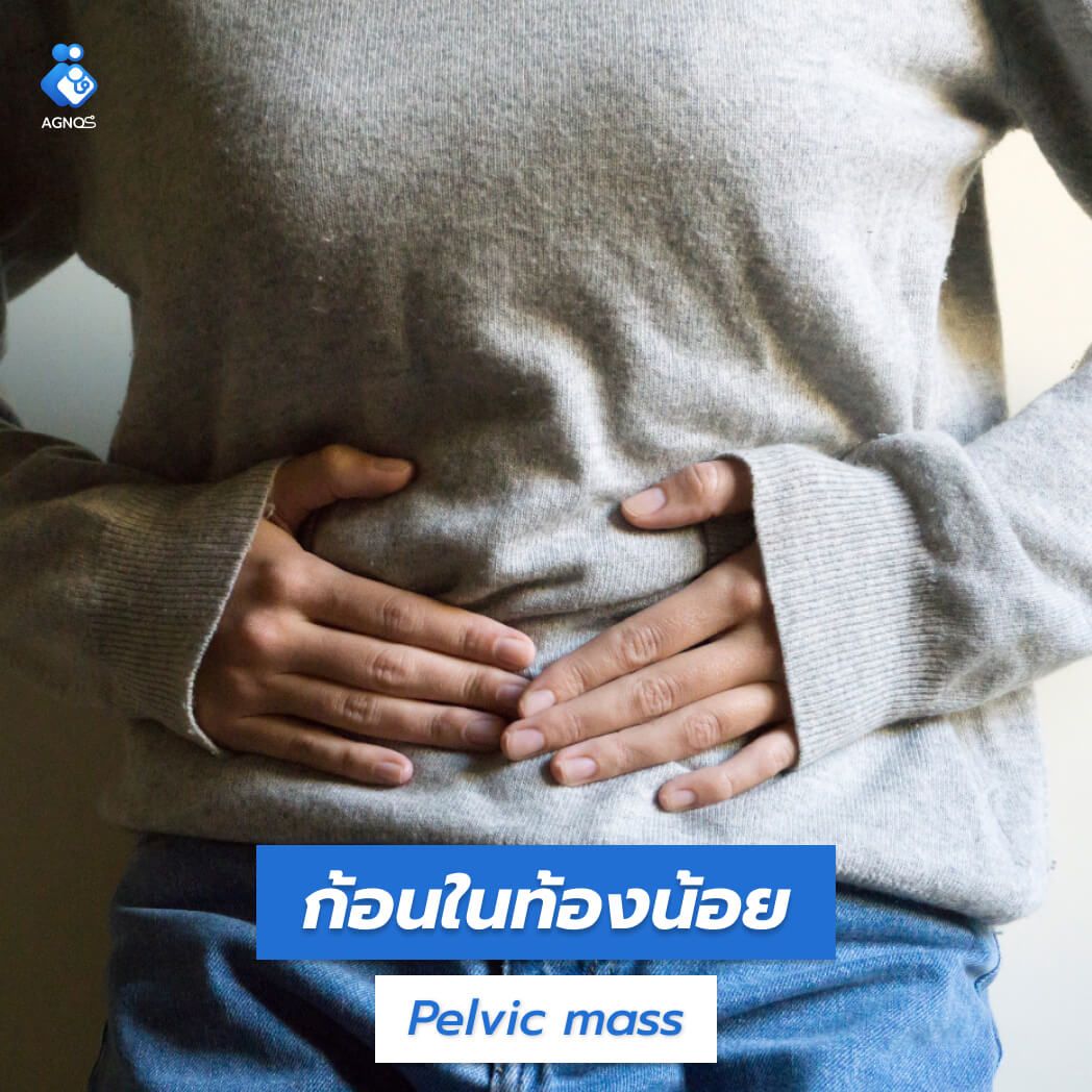 ก้อนในท้องน้อย (Pelvic mass unspecified)