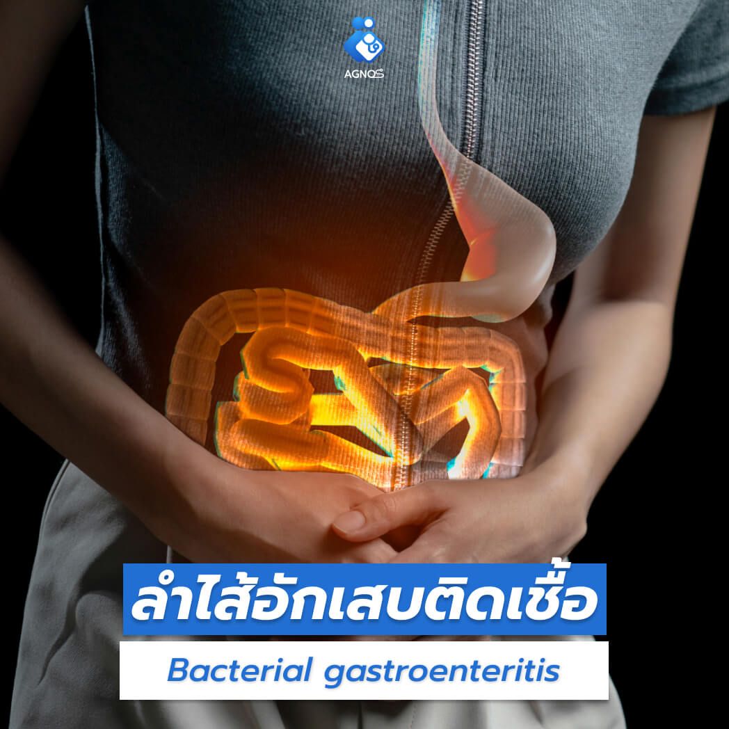ลำไส้อักเสบติดเชื้อ
(Bacterial gastroenteritis)
