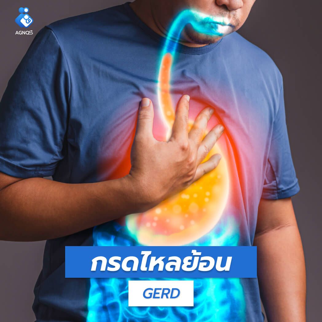 กรดไหลย้อน (GERD)