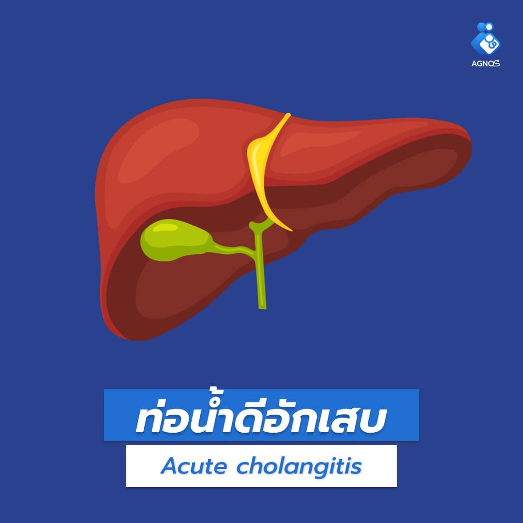 ท่อน้ำดีอักเสบ (Acute
cholangitis)