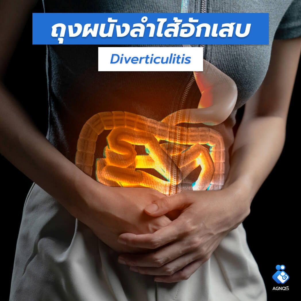 ถุงผนังลำไส้อักเสบ
(Diverticulitis)