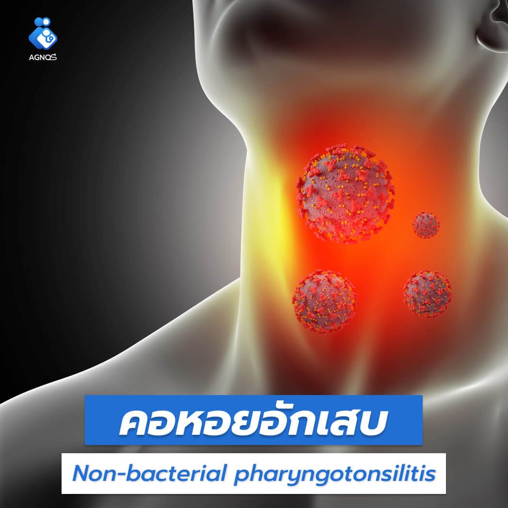 คอหอยอักเสบ
(Non-bacterial pharyngotonsillitis)