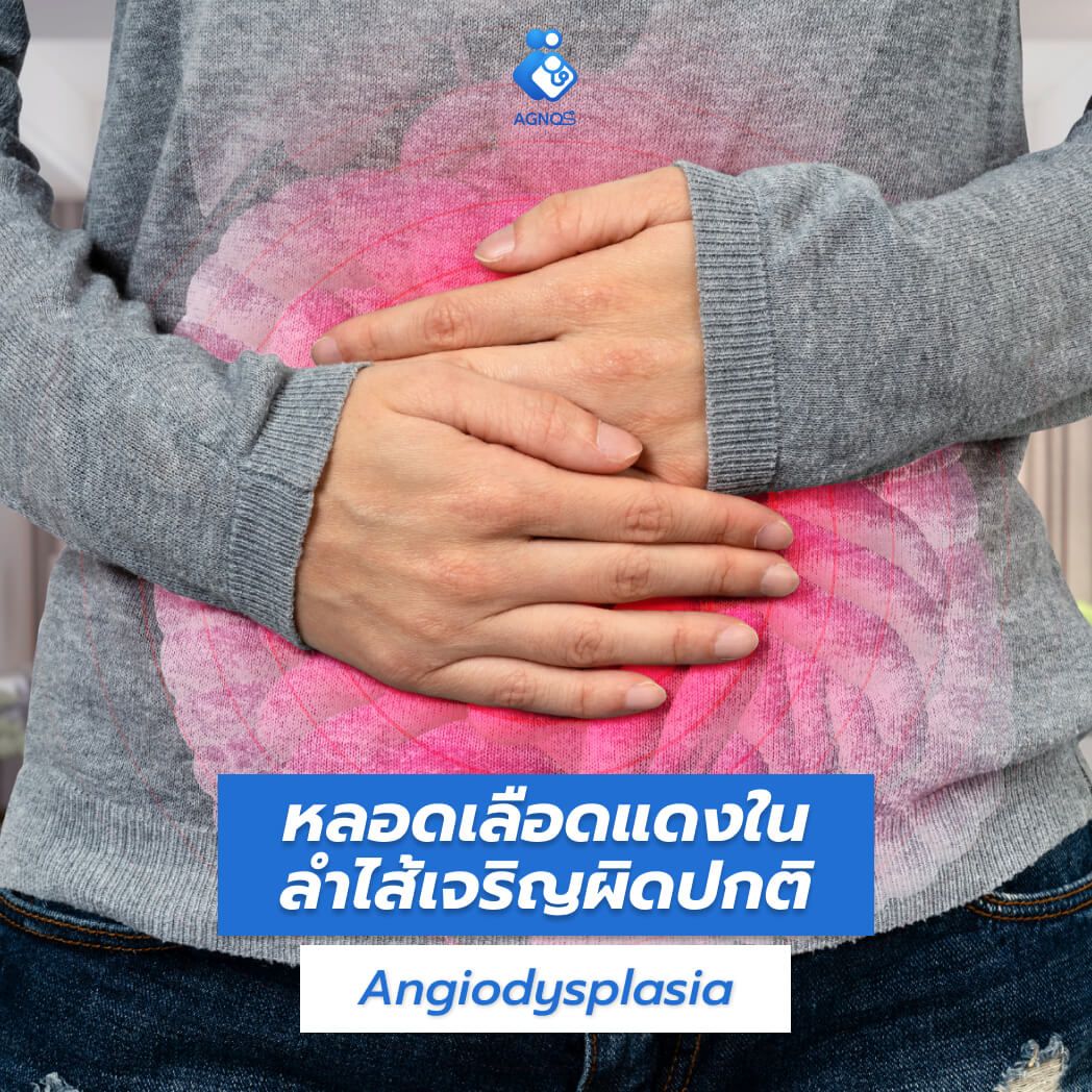 หลอดเลือดในลำไส้เจริญผิดปกติ
(Angiodysplasia)
