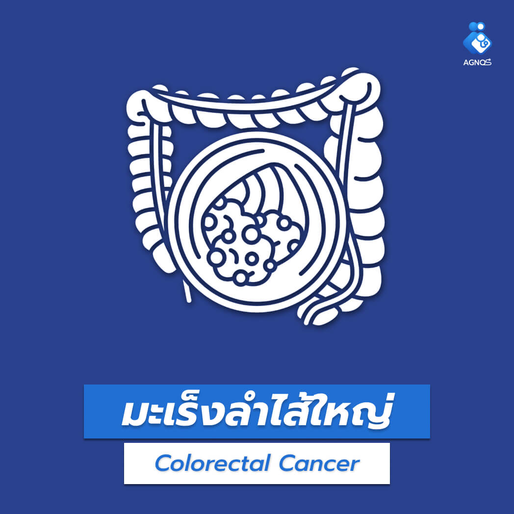มะเร็งลำไส้ใหญ่ (Colorectal
Cancer)