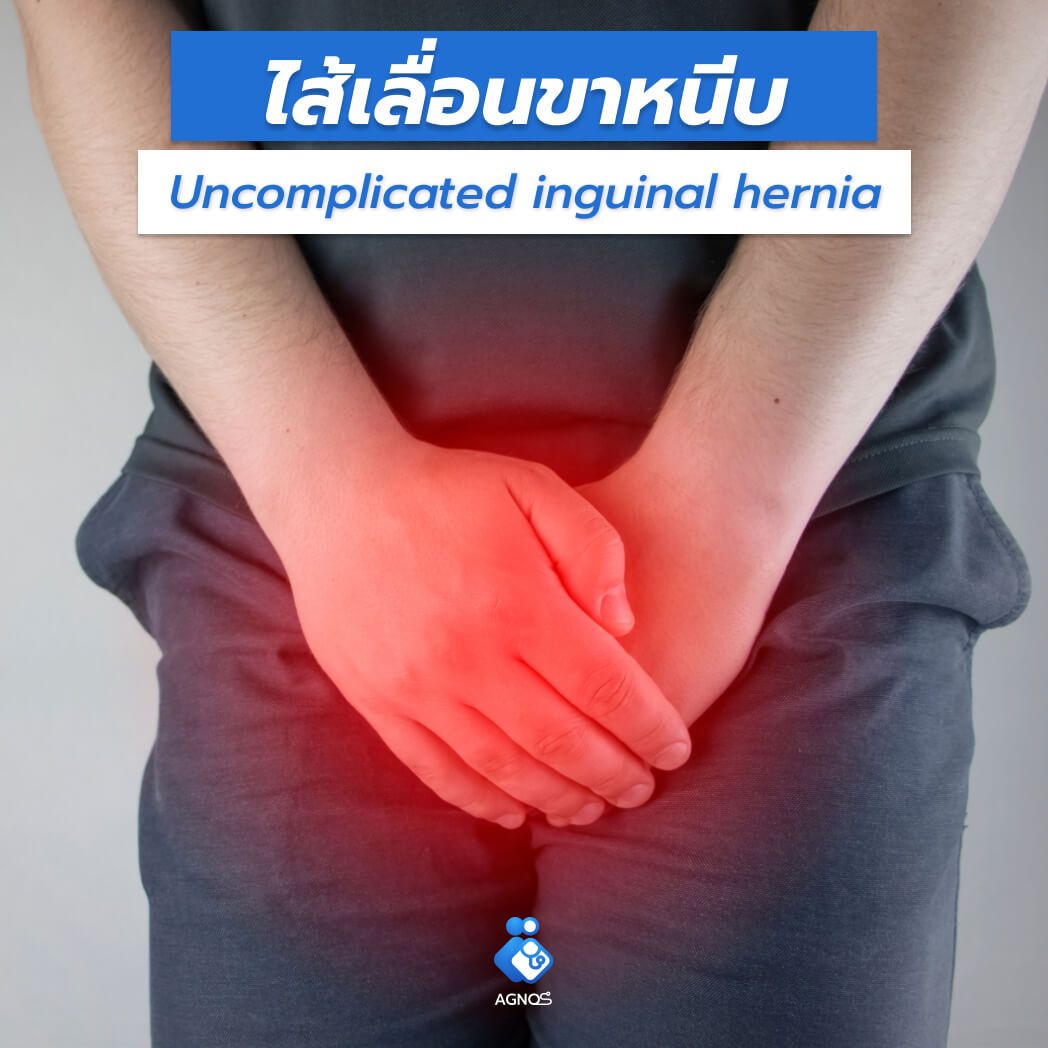 ไส้เลื่อนขาหนีบ
(Uncomplicated inguinal hernia)