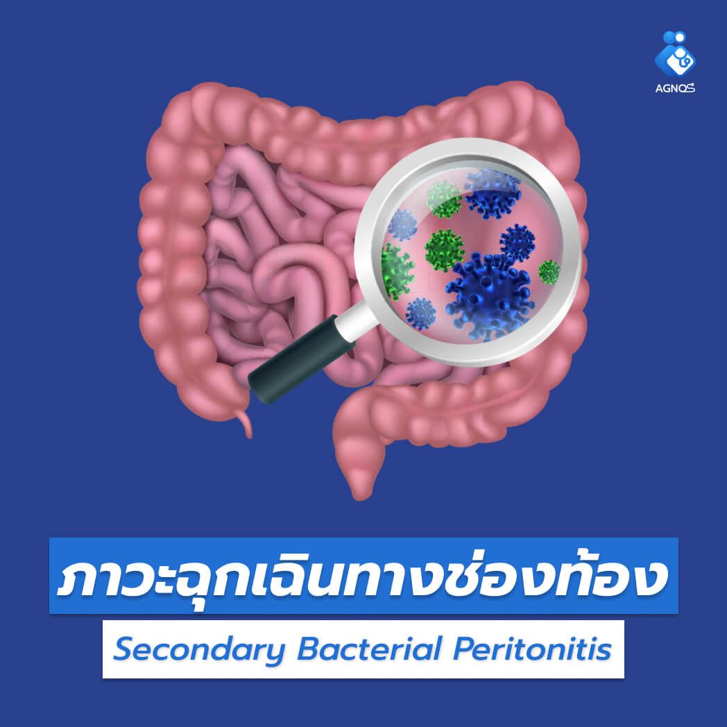 ภาวะฉุกเฉินทางช่องท้อง
(Secondary Bacterial Peritonitis)