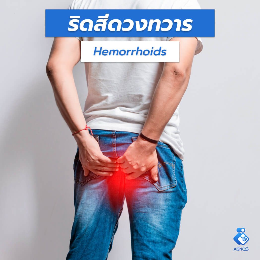 ริดสีดวงทวาร (Hemorrhoids)