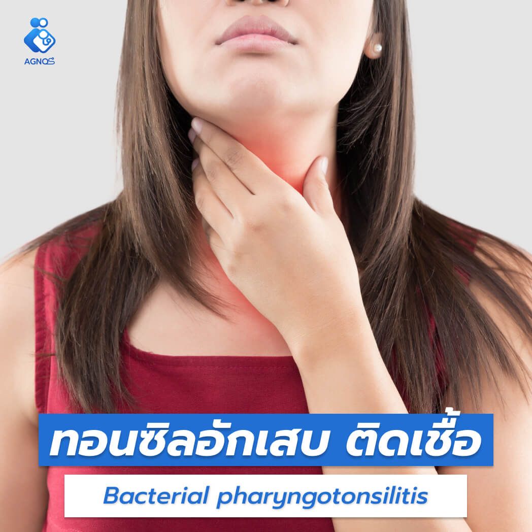 ทอนซิลอักเสบ ติดเชื้อ
(Bacterial pharyngotonsillitis)