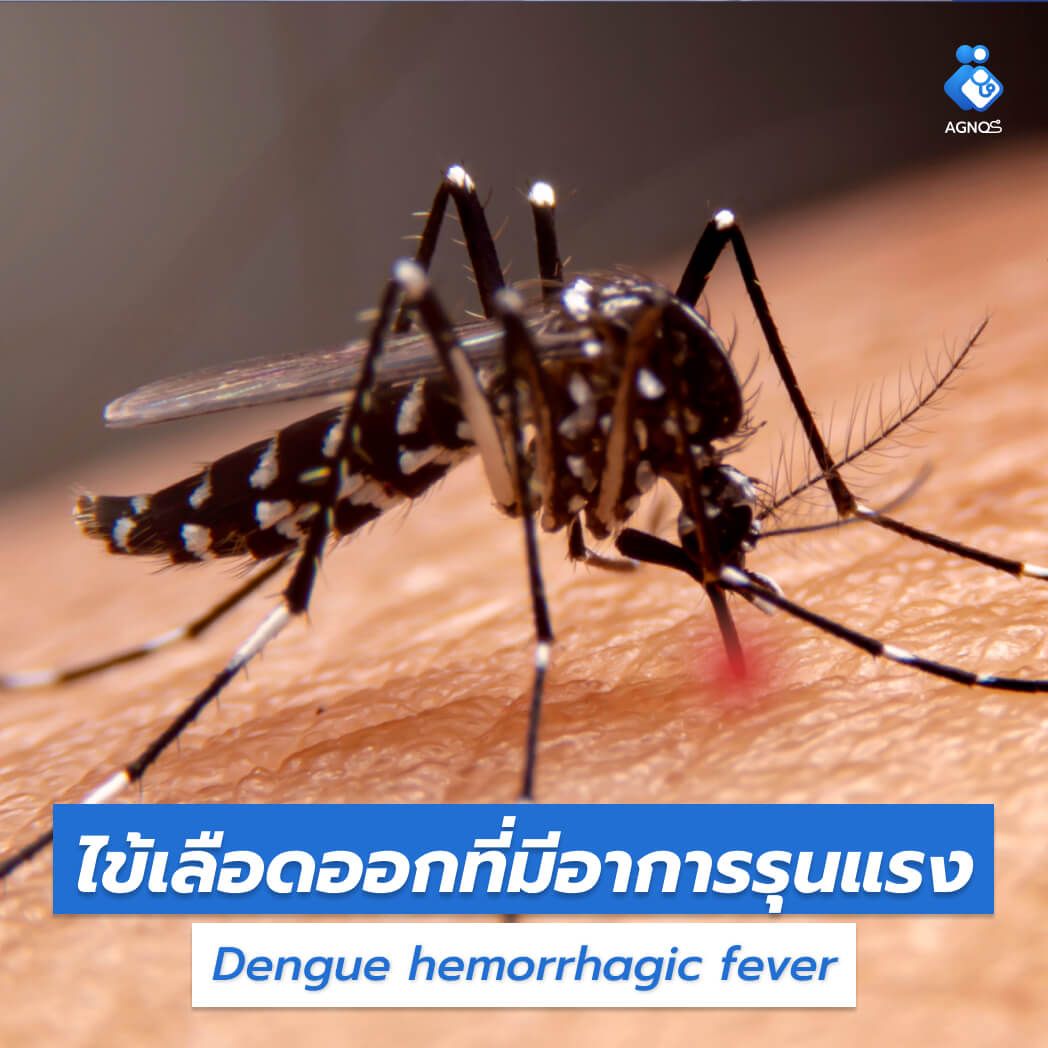 ไข้เลือดออกที่มีอาการรุนแรง
(Dengue hemorrhagic fever)