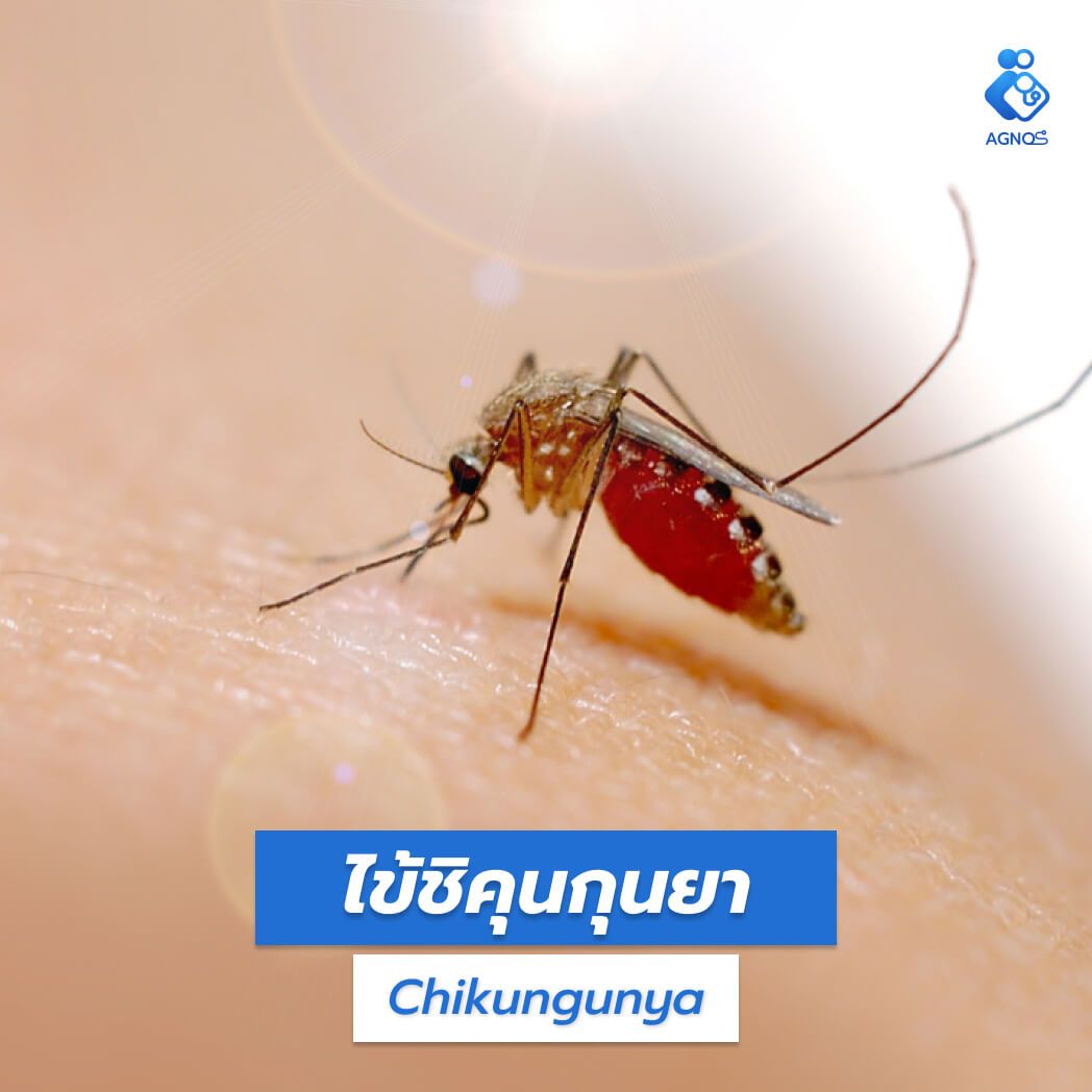 ไข้ชิคุนกุนยา (Chikungunya)