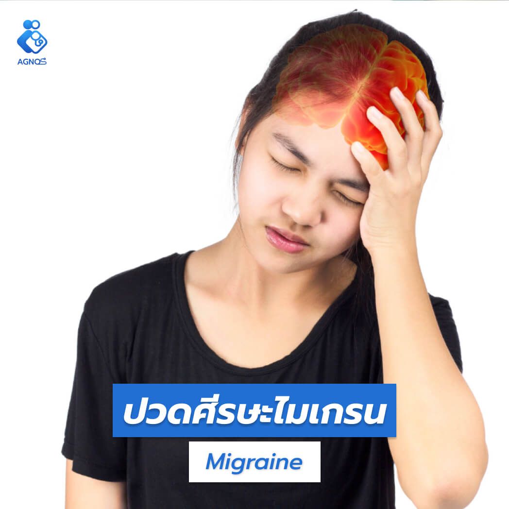 ปวดศีรษะไมเกรน (Migraine)