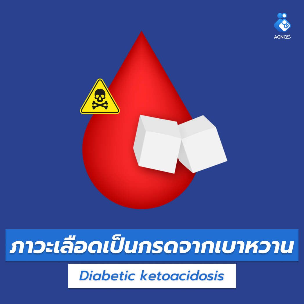 ภาวะเลือดเป็นกรดจากเบาหวาน
(Diabetic ketoacidosis)