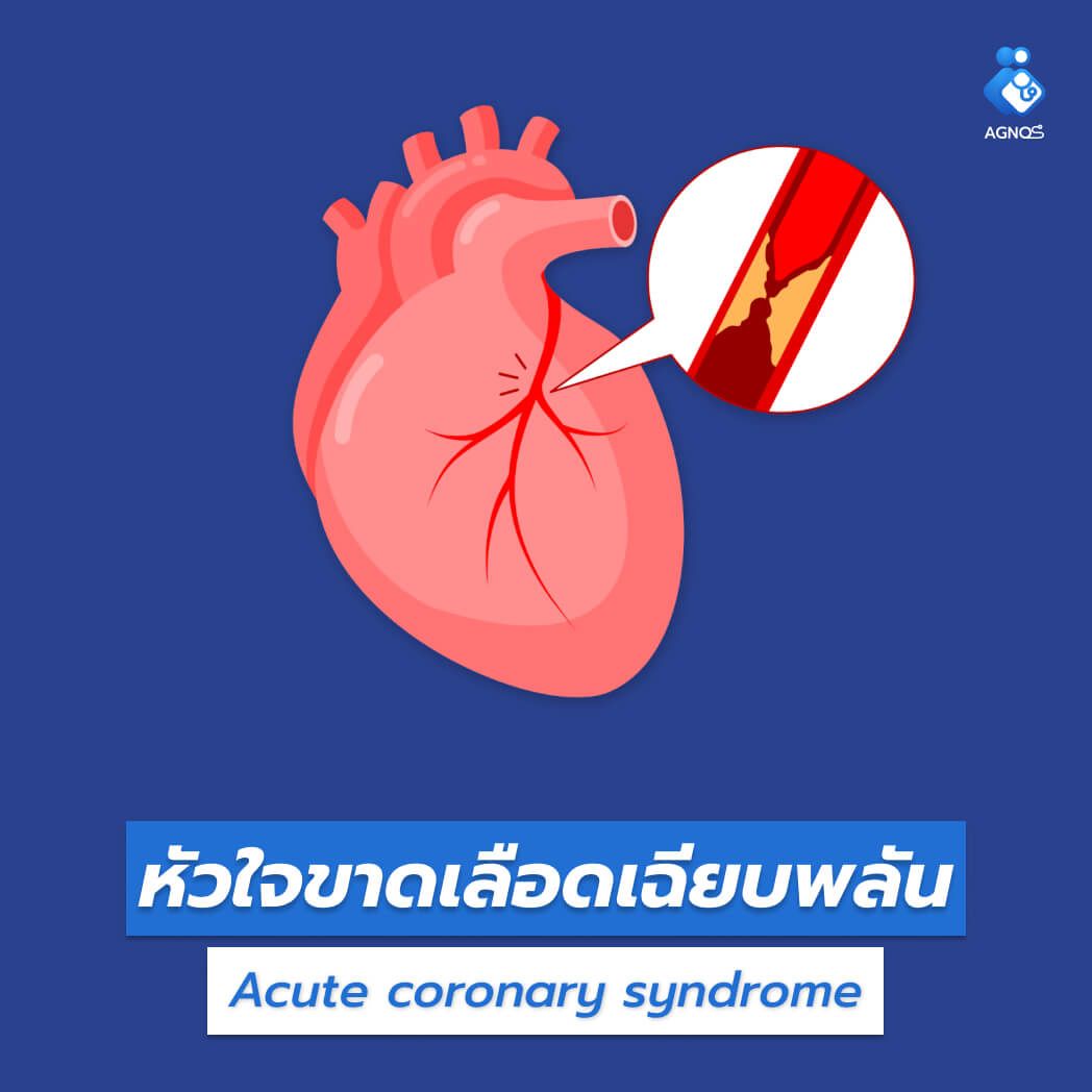 หัวใจขาดเลือดเฉียบพลัน
(Acute coronary syndrome)