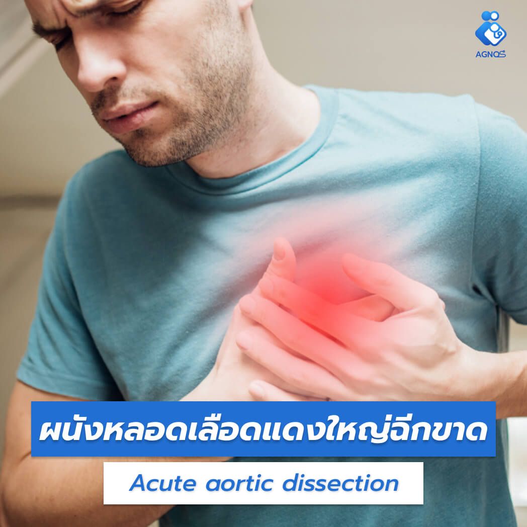 ผนังหลอดเลือดแดงใหญ่ฉีกขาด
(Acute aortic dissection)
