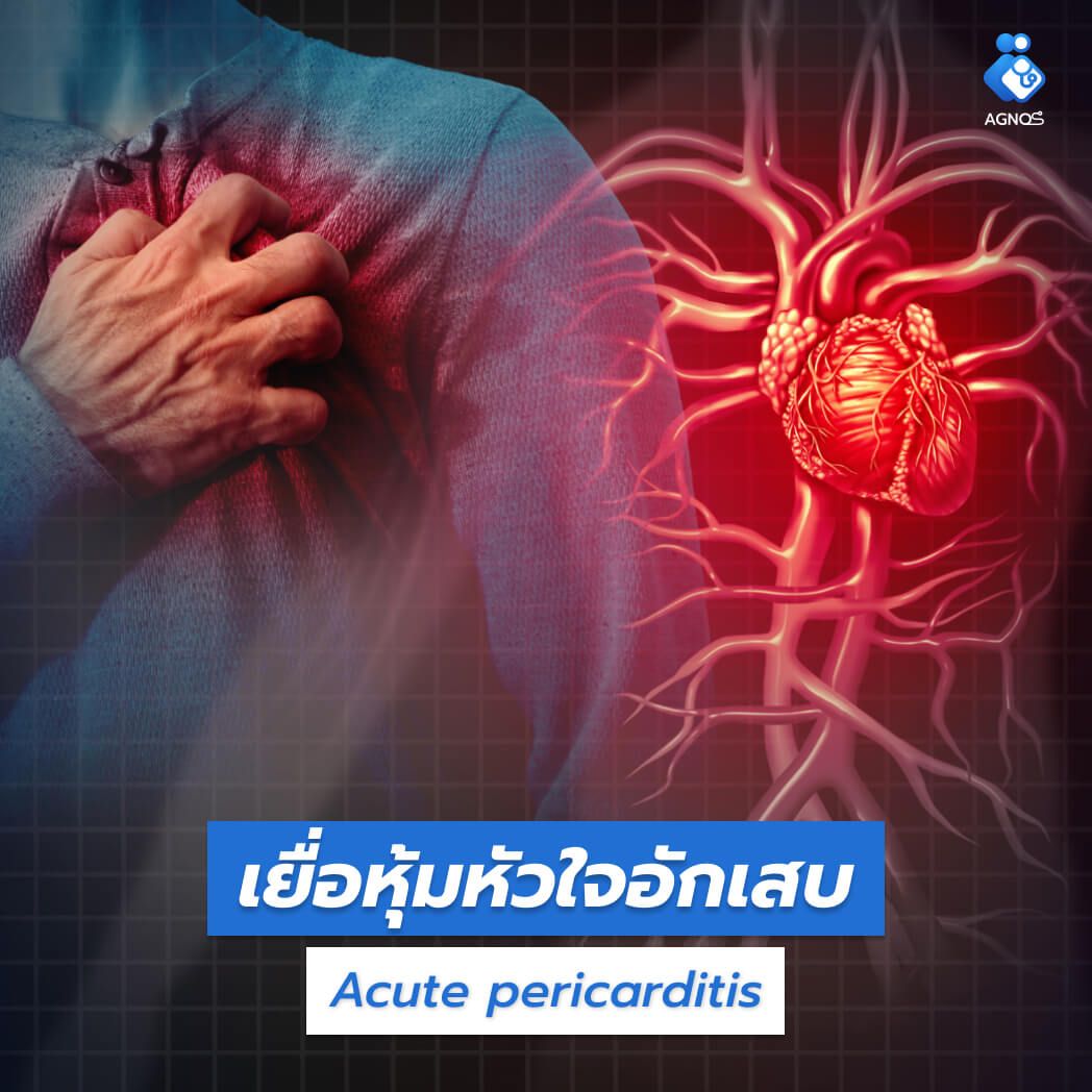 เยื่อหุ้มหัวใจอักเสบ (Acute
pericarditis)
