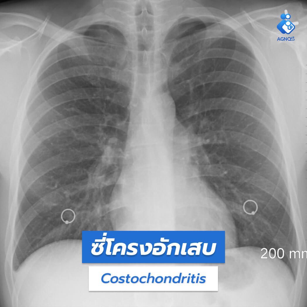 ซี่โครงอักเสบ (Costochondritis)